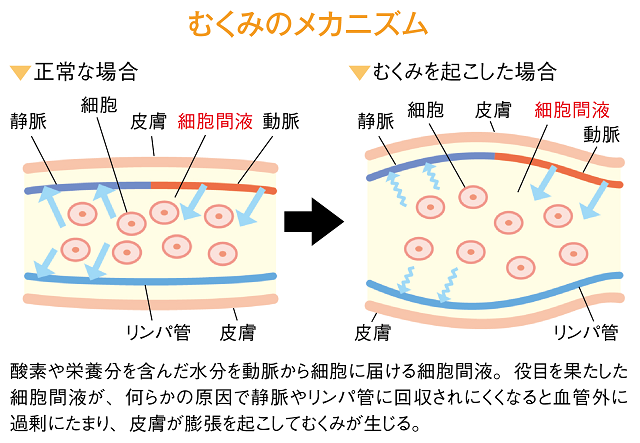 むくみを引き起こす原因